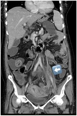 Clinical Characteristics and Management of Ovarian Vein Thrombosis: A Case Series